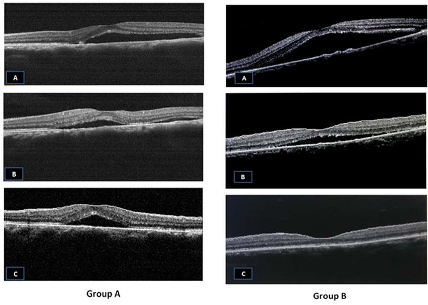 Combined Argon Laser and Low Dose Acetylsalicylic acid in Treatment of Acute Central Serous Chorioretinopathy